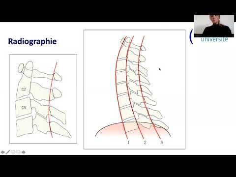 Vidéo: Scanner Du Rachis Cervical: Objectif, Procédure Et Risques