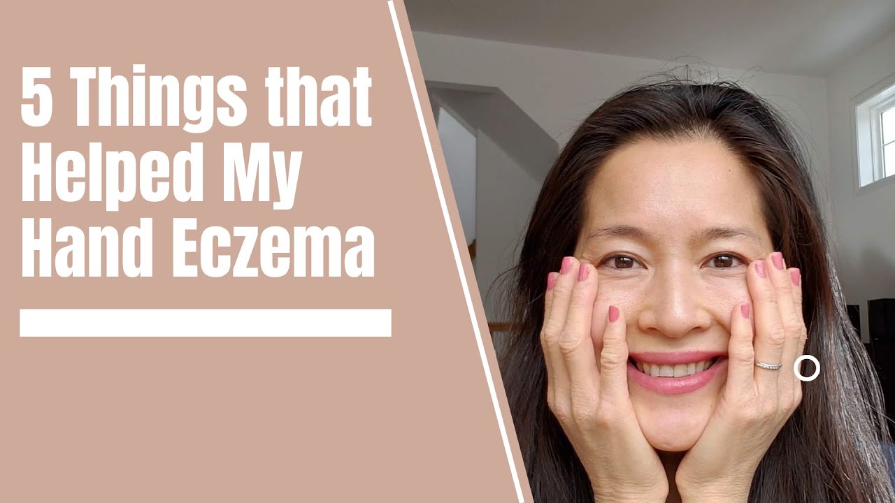 5 things that helped my hand eczema 