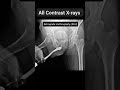 All Contrast X-ray #medicalimaging #radiographer #radiography #radiology #xray #xraytechnician