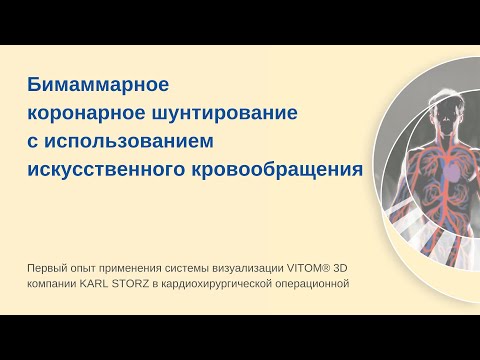 Бимаммарное коронарное шунтирование с использованием искусственного кровообращения.