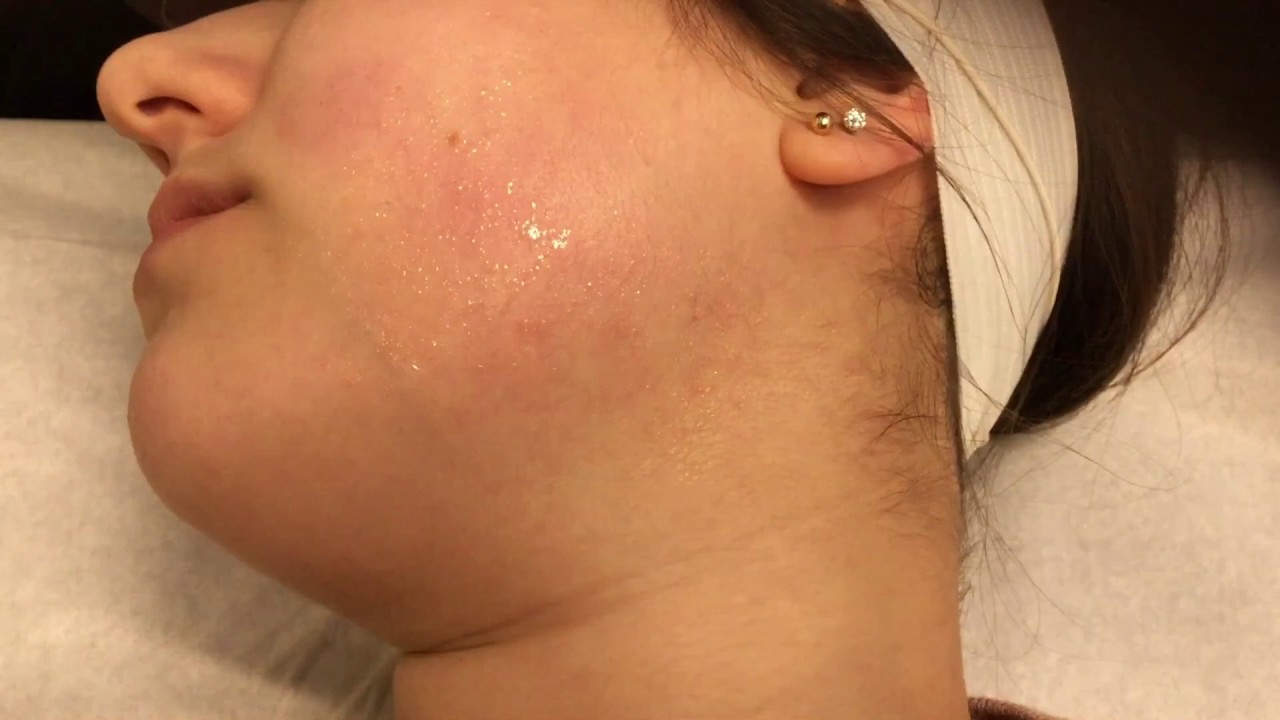 Laser treatment for facial veins YouTube