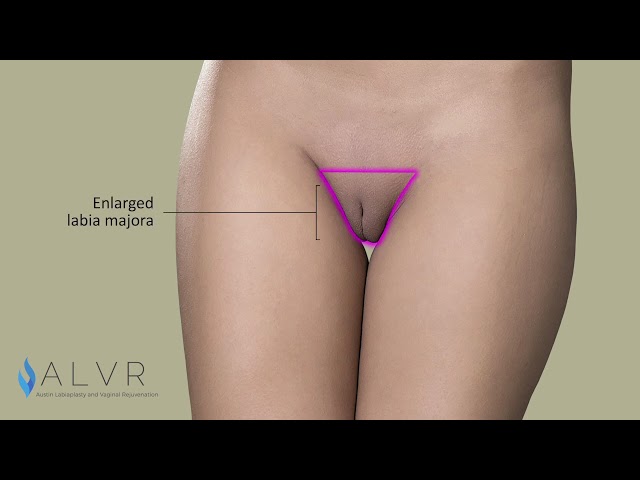 Labia Majora Reduction Animation - Front View class=