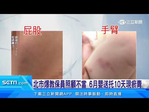 北市爆教保員照顧不當 6月嬰送托10天現瘀青｜三立新聞網 SETN.com
