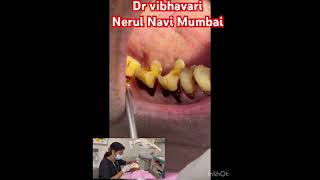 Tabaco stain removal #scaling #drvibhavaridental #whitening#cleaning