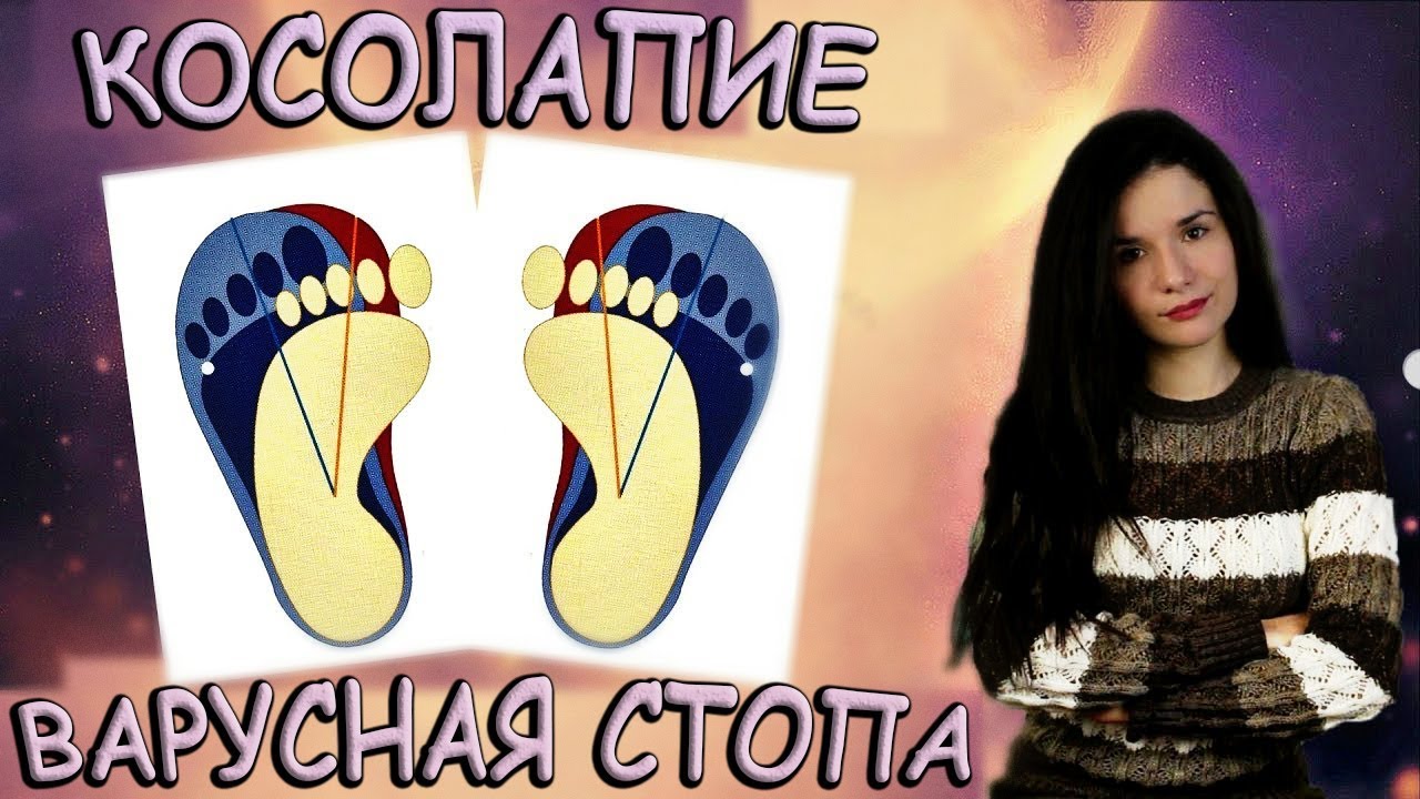 Косолапие / Варусная стопа