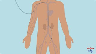 Traitement Des Varicocèles Par Embolisation - Chirurgie Vasculaire Mini-Invasive