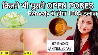 OPEN PORES,LARGE PORES,CLOGGED PORES का 100%इलाज सिर्फ 15 दिनों में |Get Rid Of Open Pores Naturally