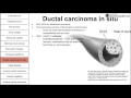 Female breast pathology