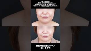 今はこんな脂肪吸引もあるんです！#脂肪吸引注射 #ライトな脂肪吸引 #水口将志院長 #湘南美容美容クリニック八王子院
