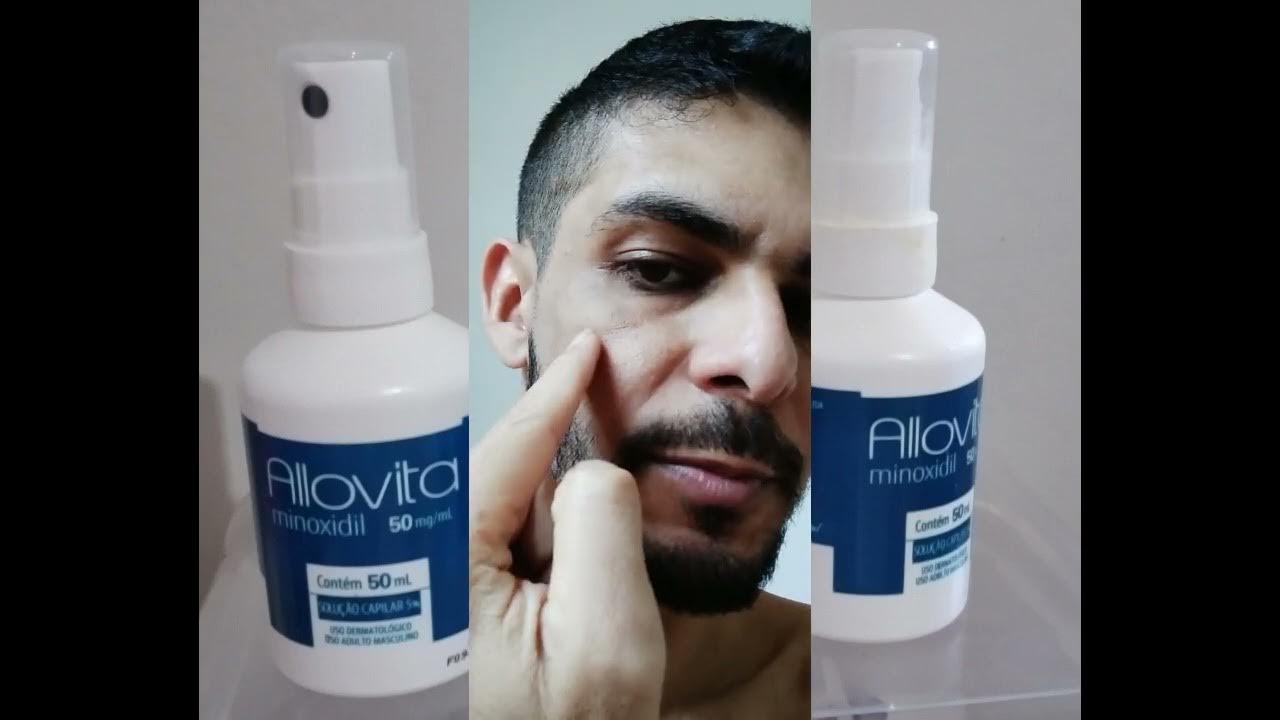 minoxidil-allovita-parte-2-mostrando-a-evolu-o-com-uso-de-apenas