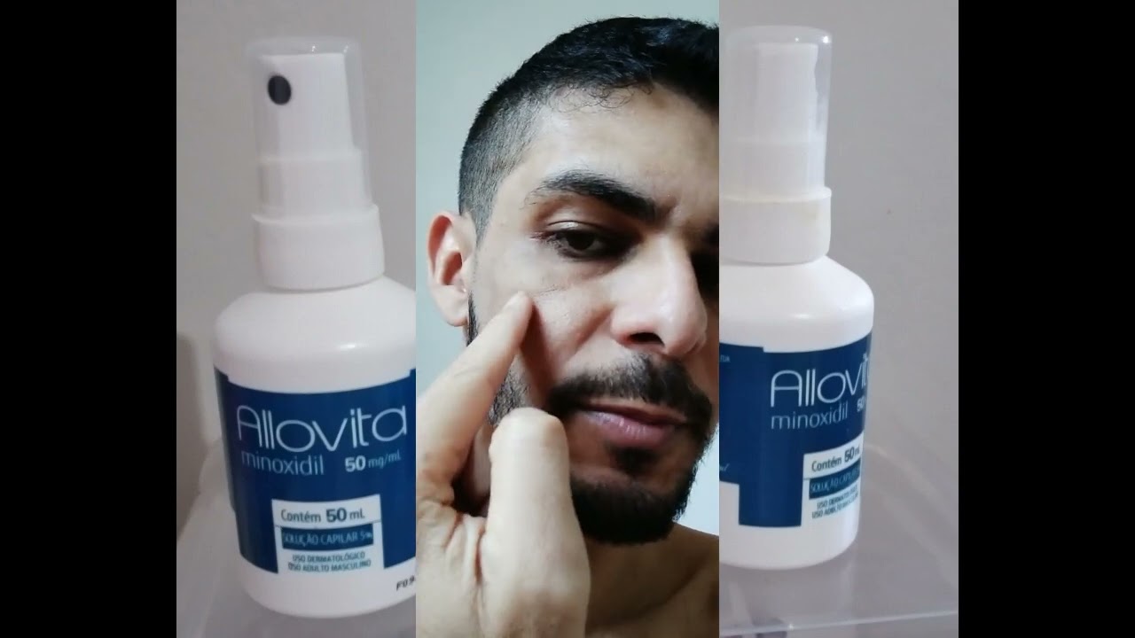 Minoxidil Allovita Parte 2 Mostrando A Evolu o Com Uso De Apenas Minoxidil Allovita Parte 2 Mostrando A Evolu o Com Uso De Apenas