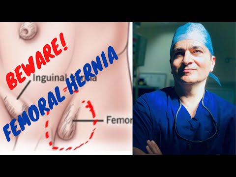 Femoral Hernia (appears as groin lump) - understand why it can be dangerous.
