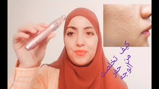 سر صفاء بشرتي?وداعا للكلف و البقع و المسامات الواسعة?dermapen