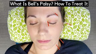 What Is Bell's Palsy? How To Treat It