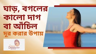 ঘাড় ও বগলের কালো দাগ বা আঁচিল দূর করার উপায় । Treatment for Acanthosis nigricans