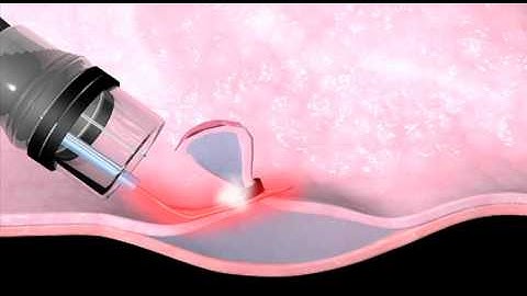 Medical Treatment for Barretts Esophagus, Endoscopic Mucosal Resection-Mayo Clinic