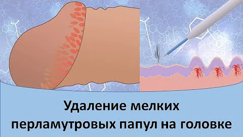 Удаление мелких перламутровых папул на головке