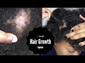 5 Power Tips to Grow Natural Hair | Traction Alopecia Update |