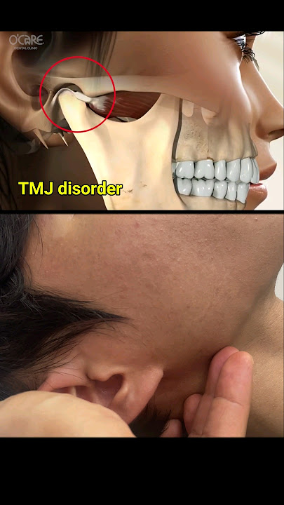 Temporomandibular joint disorder and treatment #tmj #dental #dentist