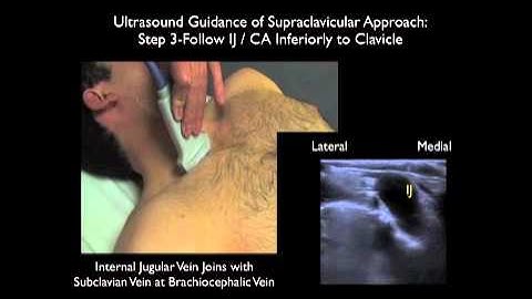 How To: Supraclavicular Approach to Subclavian Vein Cannulation - Sonosite Ultrasound