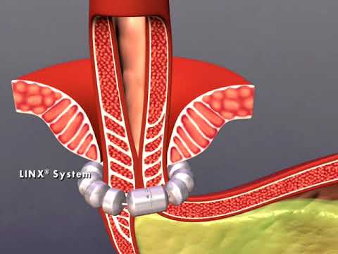 What is the LINX® Procedure? | TLC Houston's Heartburn Center - YouTube