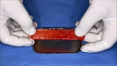 Protocol Sticky Bone S PRF Choukroun 5