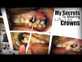 My Secrets to Making Life-Like Crowns the Match Natural Teeth in All Conditions