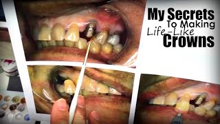 My Secrets to Making Life-Like Crowns the Match Natural Teeth in All Conditions