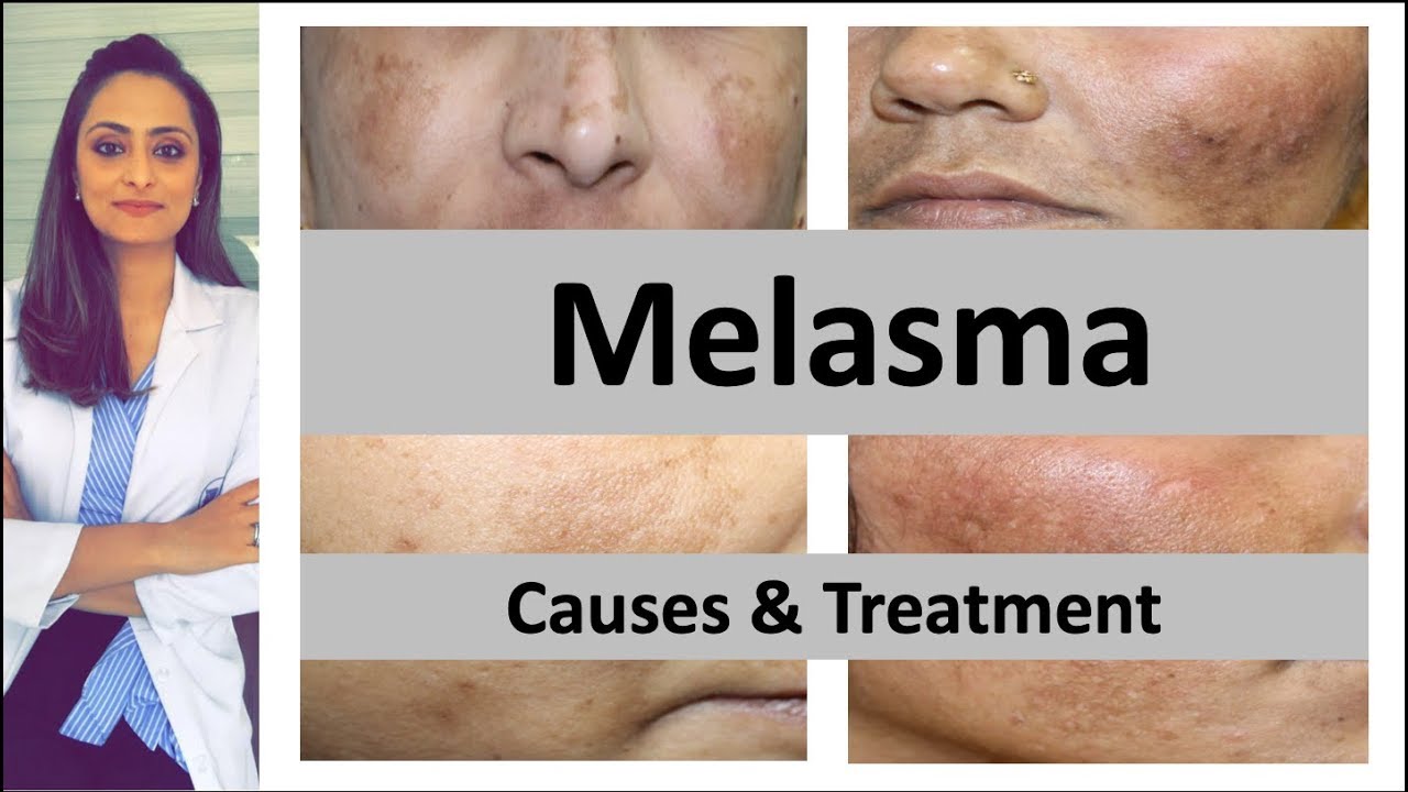 How To Treat Dark Spots Melasma Causes And Treatment Dermatologist 