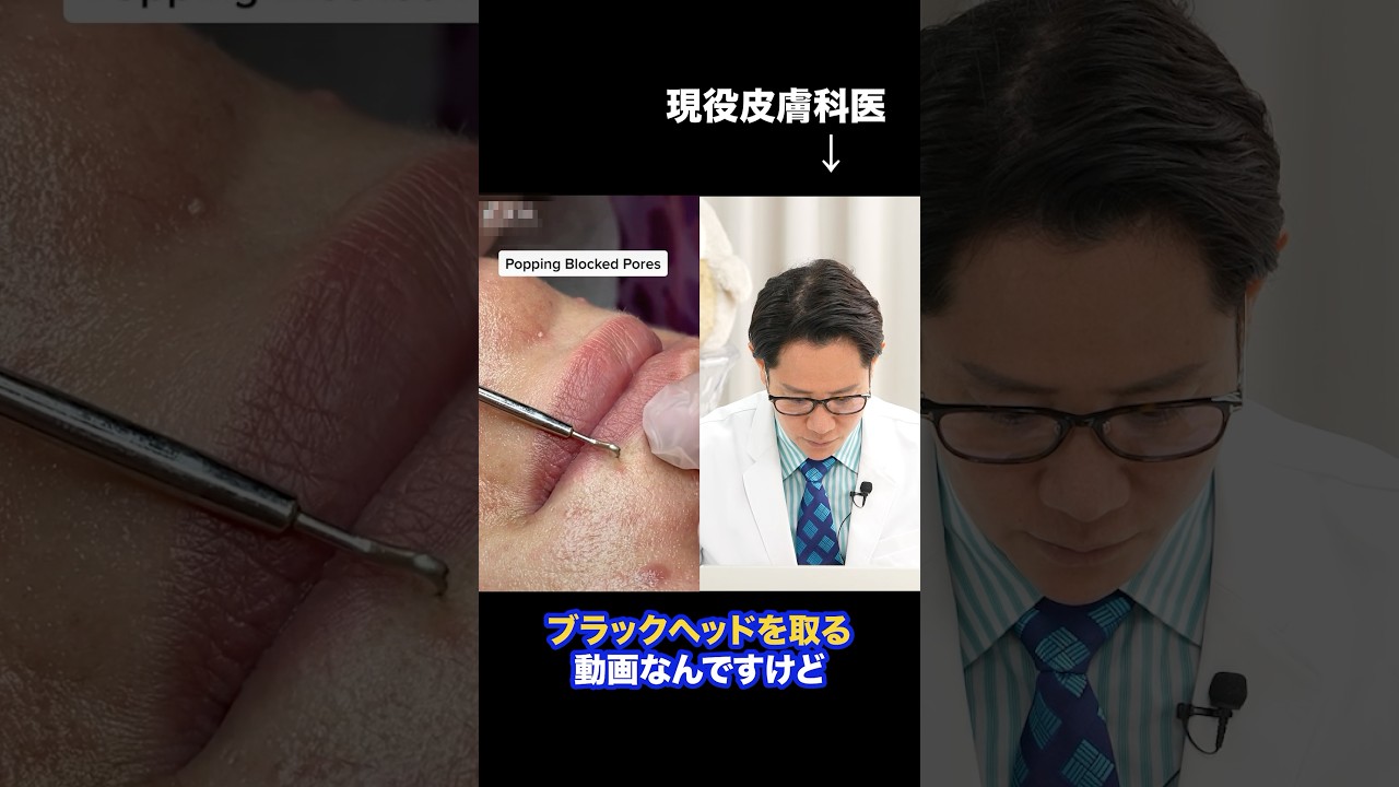 Video of Blackhead Removal Using a Needle: Commentary by a