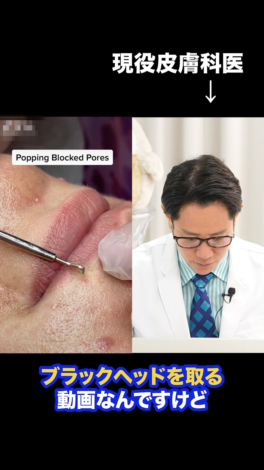BLACKHEAD REMOVAL (にきび除去) 角栓除去】超絶変化！大量のニキビを芯出しするって気持ちいい