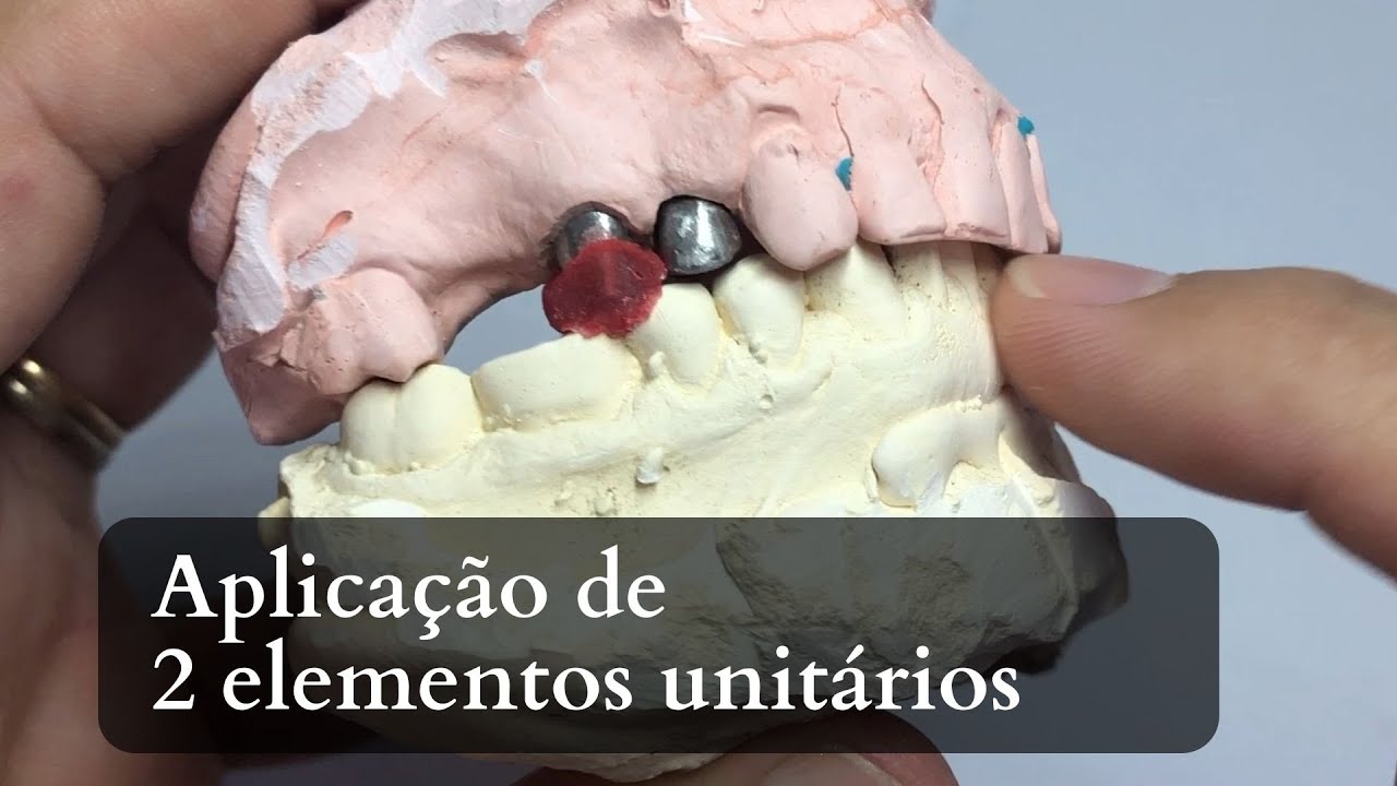 Aplicação de duas coroas metaloceramica noritake