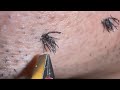 Plucking facial hair & ingown hair 774 喉髭抜き(埋没毛あり)