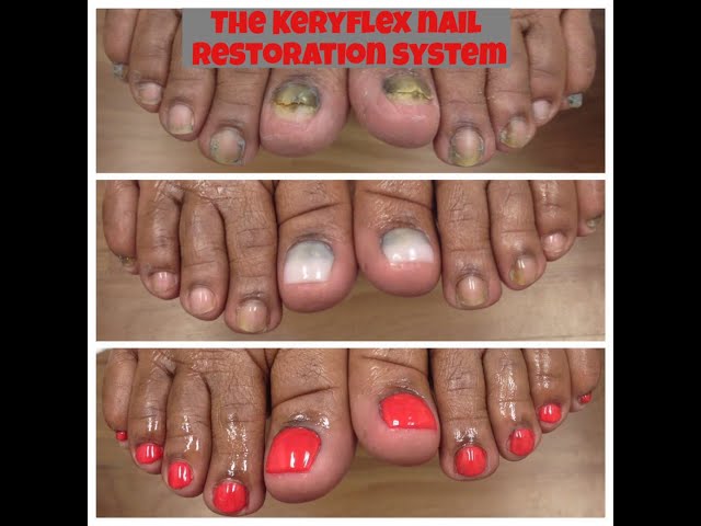 KeryFlex fingernail and toenail replacement - KeryFlex.ca — Curix | |  Experience The Curix Difference