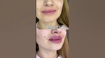 Что нельзя после увеличения губ