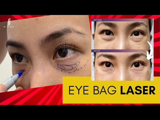 Non-Surgical Eye Bag Laser Treatment: Say Goodbye to Under-Eye Bags class=