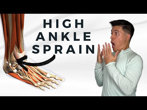 High Ankle Sprain