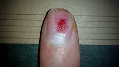 Damaged nail growing back (6 months time lapse)
