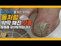 (ENG SUB)돌처럼 딱딱해진 발톱..!/발톱 케어 후 인생 최고의 선물이라고 말한 고객님/ingrown toenail/Athlete's foot-Fresh Foot