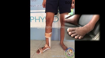 ตอนที่ 287 ความแตกต่างระหว่างอุปกรณ์ดามกันปลายเท้าตกแบบบุนุ่มและอุปกรณ์ดามกันปลายเท้าตกแบบปรับองศา