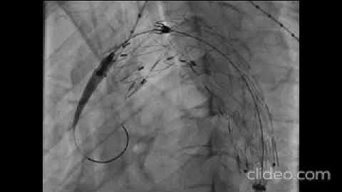 TEVAR for aortic dissection and aneurysm at AIIMS BHUBANESWAR ON 13-01-2023
