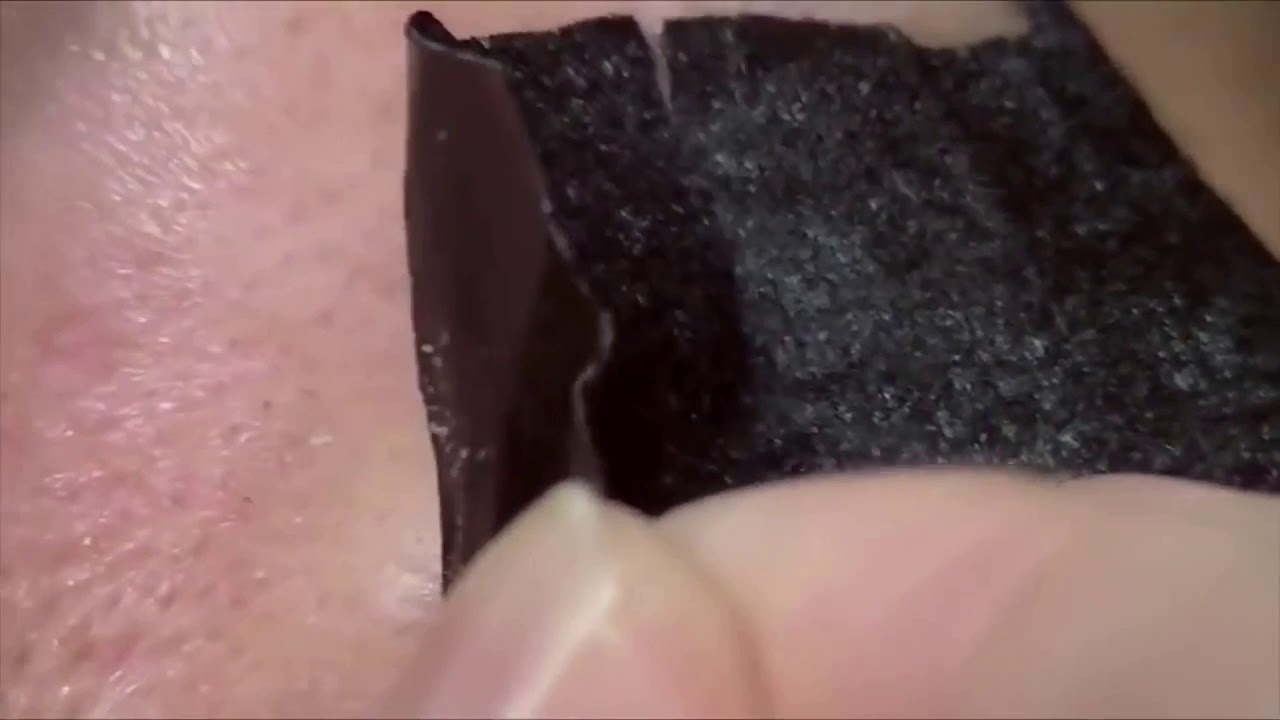 Nose Full Of Blackheads, Blackheads Removal With Pore Strips