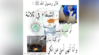 قال رسول الله ﷺ الشفاء في ثلاثة ، في شربة عسل و شرطة محجم و كية بنار ، و أنا أنهى أمتي عن الكي 