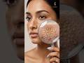 Do you know about MELASMA ⁉️🙋