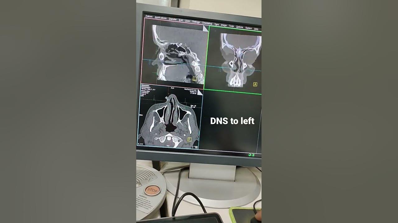Dns With Turbinate Hypertrophy