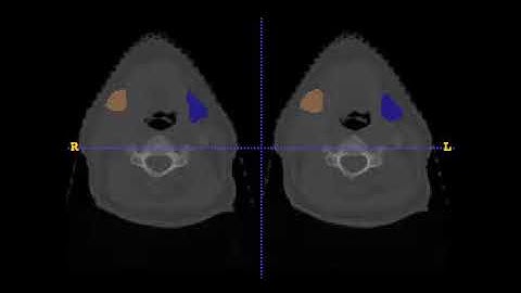 AnatomyNet-for-anatomical-segmentation test demo 3