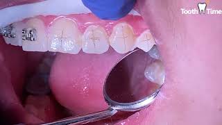 Orthodontic Bracket Repositioning - changing 4 brackets - Correct form to brush with braces