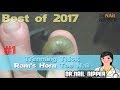 #1 Best of 2017 - Trimming Thick Ram's Horn Toe Nail - Dr Nail Nipper