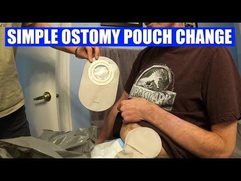 Changing a colostomy bag : quick and easy! - YouTube