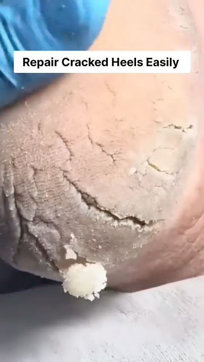 Get Rid Of Cracked Heels Naturally | Cracked Foot Cream #shorts #skincare